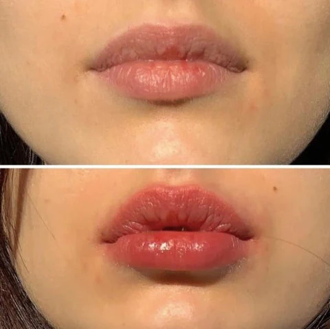 PlumpGlow™ | Lippenvergrößerungsset