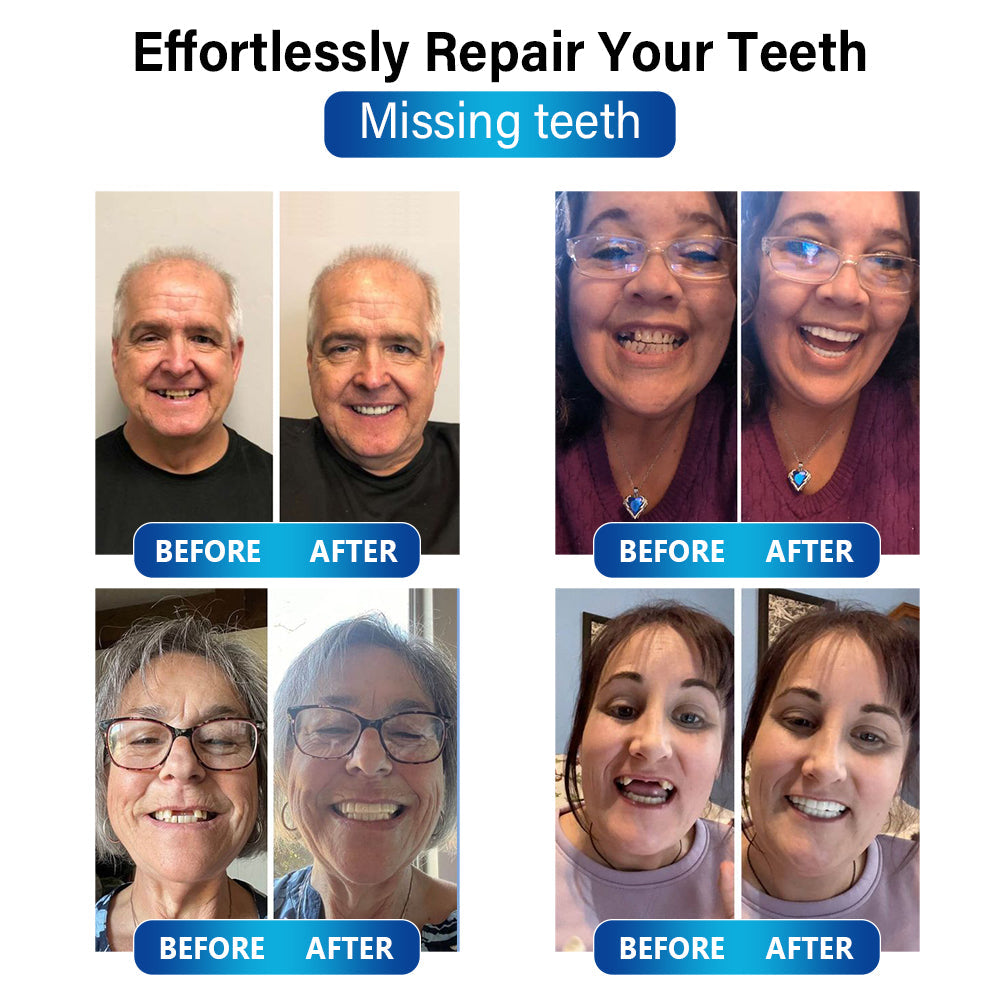 50% RABATT | SmileCraft™ | Blaulicht-Härtungslampe und Zahnersatzmaterialien 🏥TGA-zertifiziert (zum Reparieren fehlender Zähne, abgebrochener Zähne und Zahnlücken)