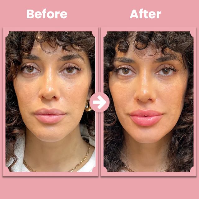 KissBloom™ | Lippenlift-Roller-Kit