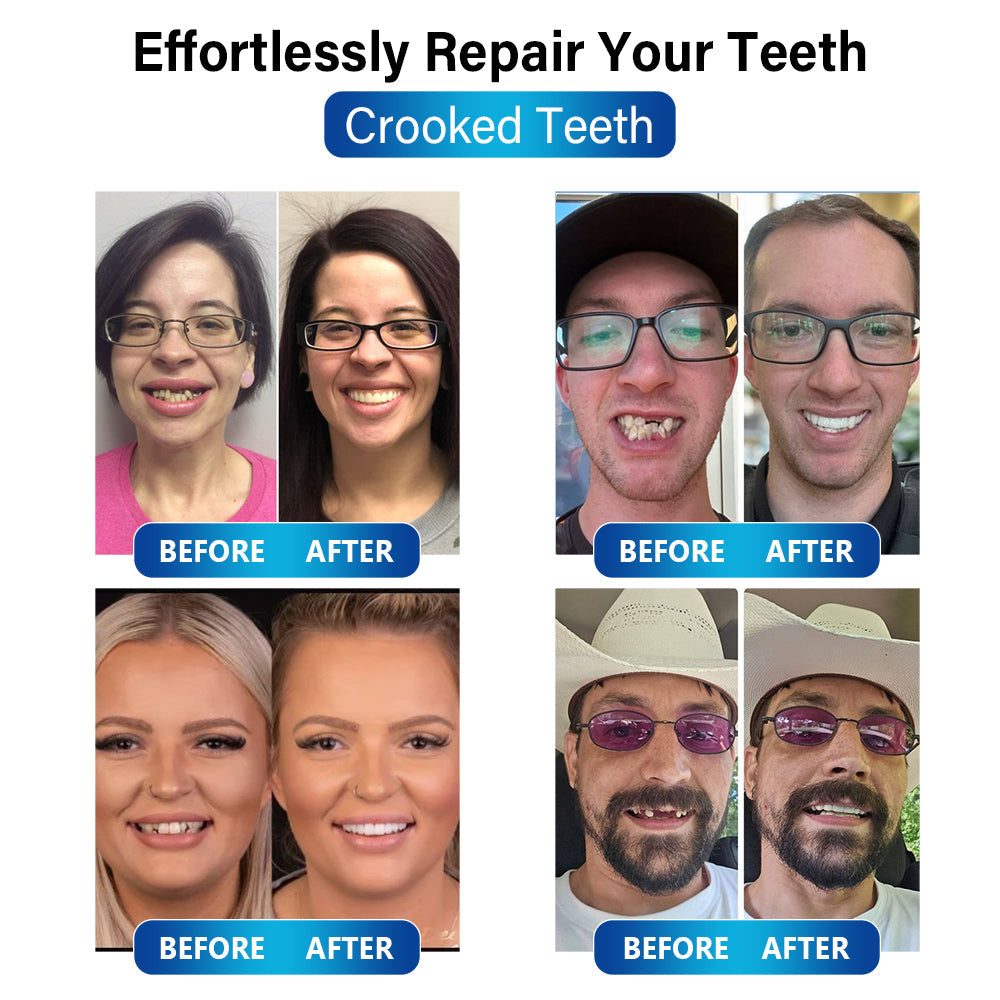 50% RABATT | SmileCraft™ | Blaulicht-Härtungslampe und Zahnersatzmaterialien 🏥TGA-zertifiziert (zum Reparieren fehlender Zähne, abgebrochener Zähne und Zahnlücken)