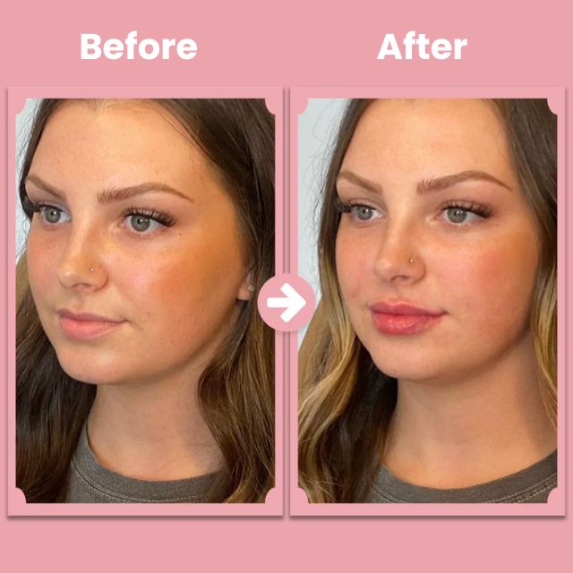 KissBloom™ | Lippenlift-Roller-Kit