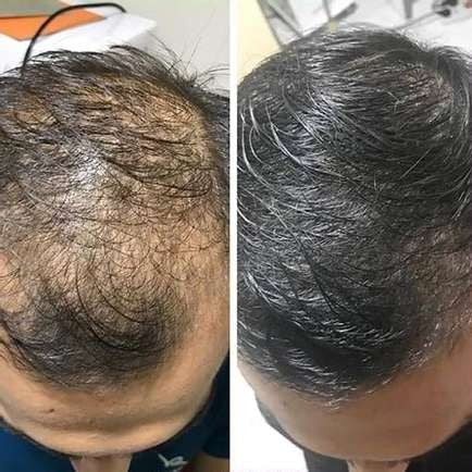 1+1 GRATIS | RegrowBar™ | Anti-Haarausfall