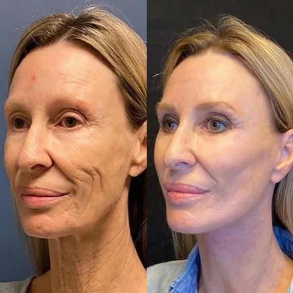 1+1 GRATIS | GlowTox™ | Glatte, jugendliche Haut mit Botox Anti-Aging Serum