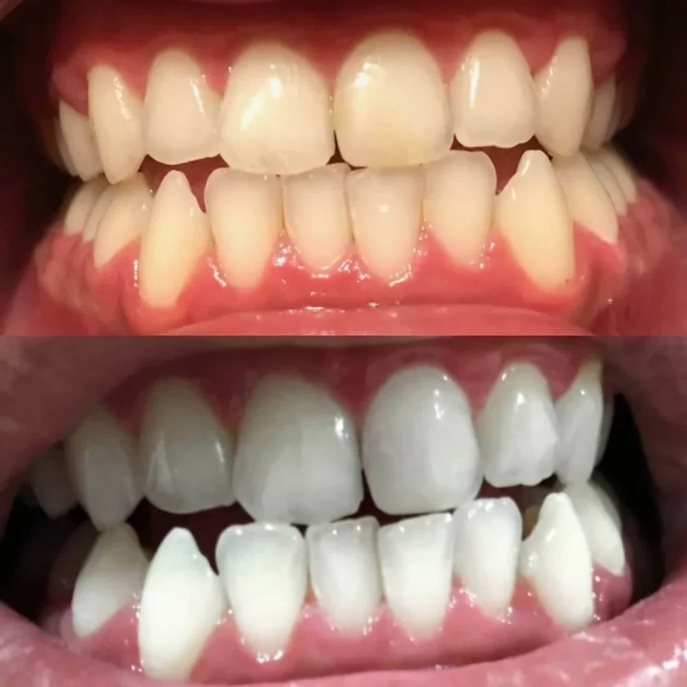 RadiantSmile® | Instant Teeth Whitener