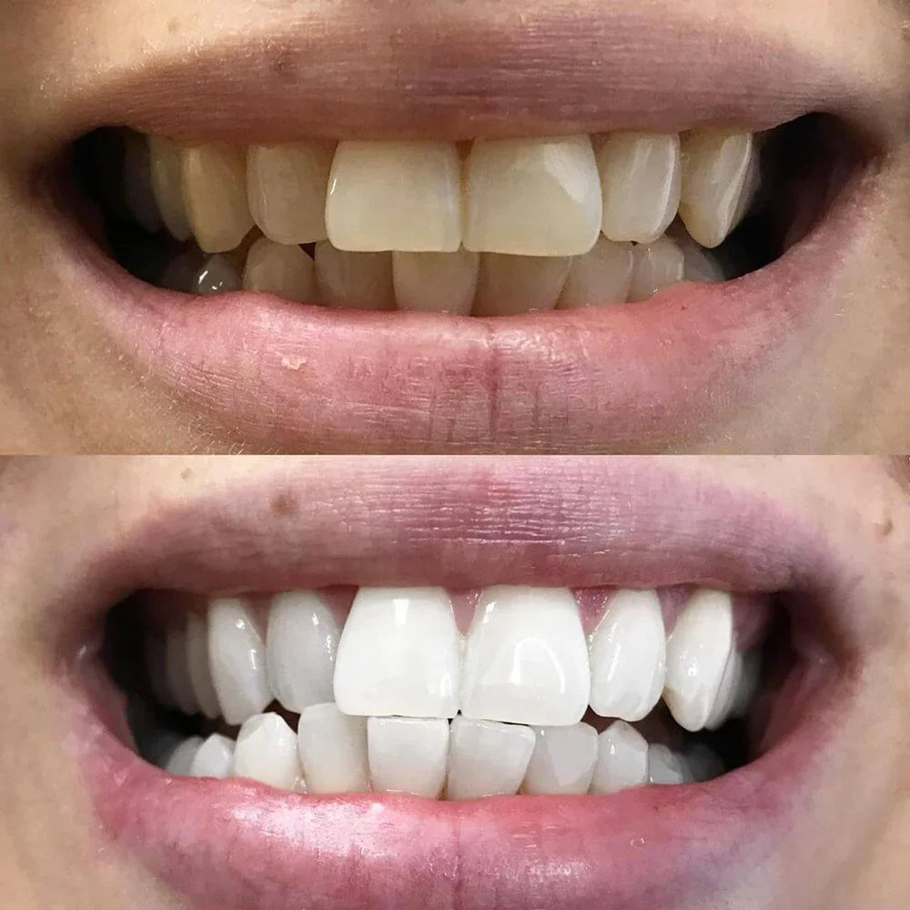 RadiantSmile® | Instant Teeth Whitener