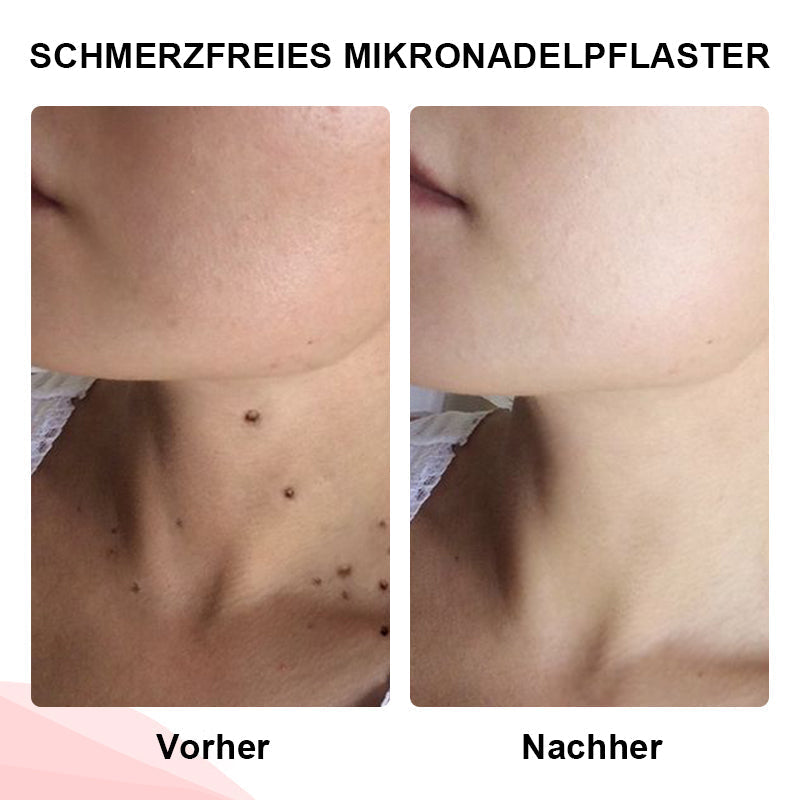 1+1 GRATIS | DermiClear™ Schmerzfreie Entfernung von Hautanhängseln