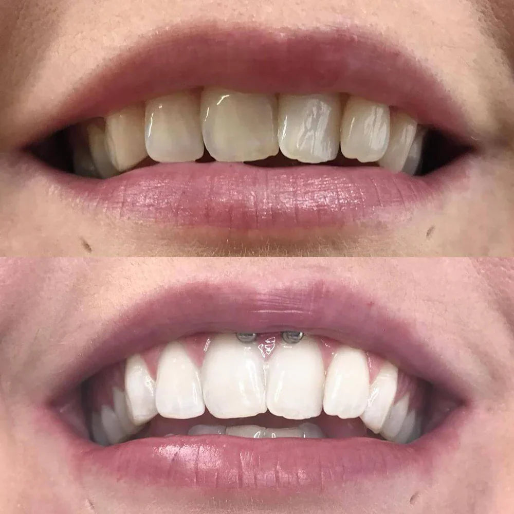 RadiantSmile® | Instant Teeth Whitener