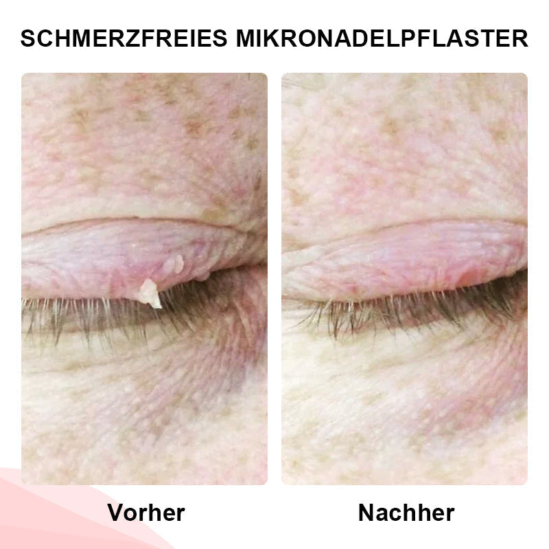 1+1 GRATIS | DermiClear™ Schmerzfreie Entfernung von Hautanhängseln