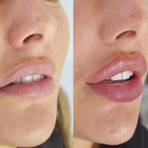 PlumpGlow™ | Lippenvergrößerungsset