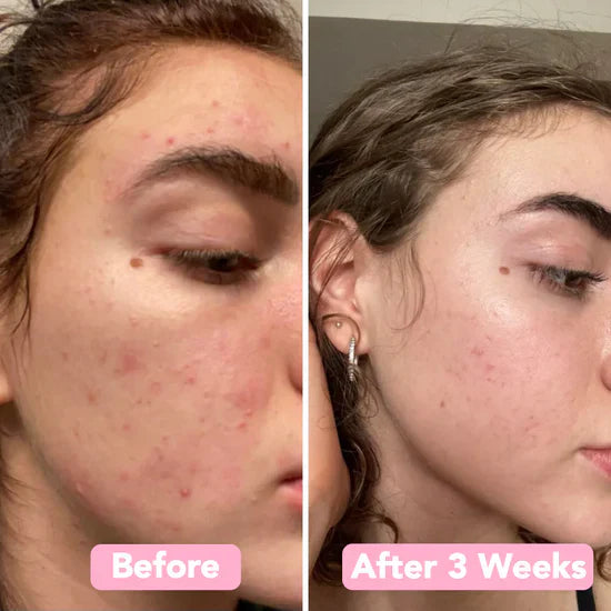Turmiclear™ | Kurkuma & Kojic schäumende Reinigungsflüssigkeit