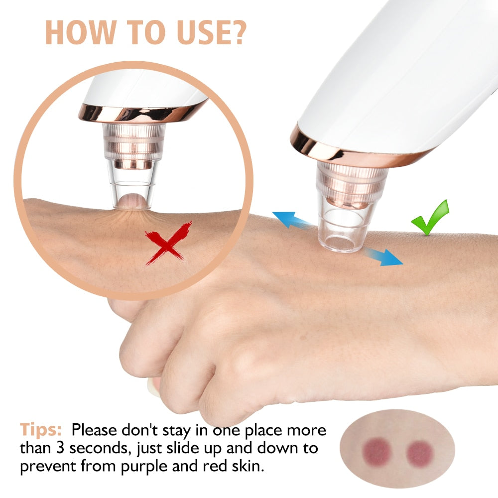 ClearSkin® | Poren-Mitesser-Entferner-Werkzeug