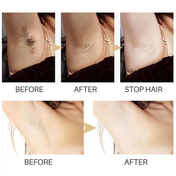 1+1 GRATIS | LumeSkin™ Dauerhafte Haarentfernung