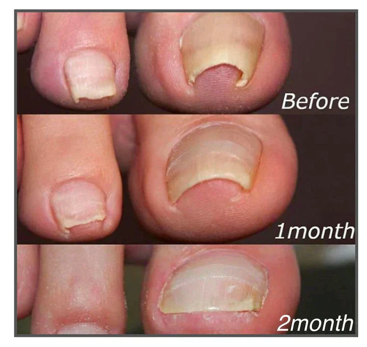 50% RABATT | NailNurture™ | Nagelpflege Schnelle Schmerzlinderung und gesundes WachstumG