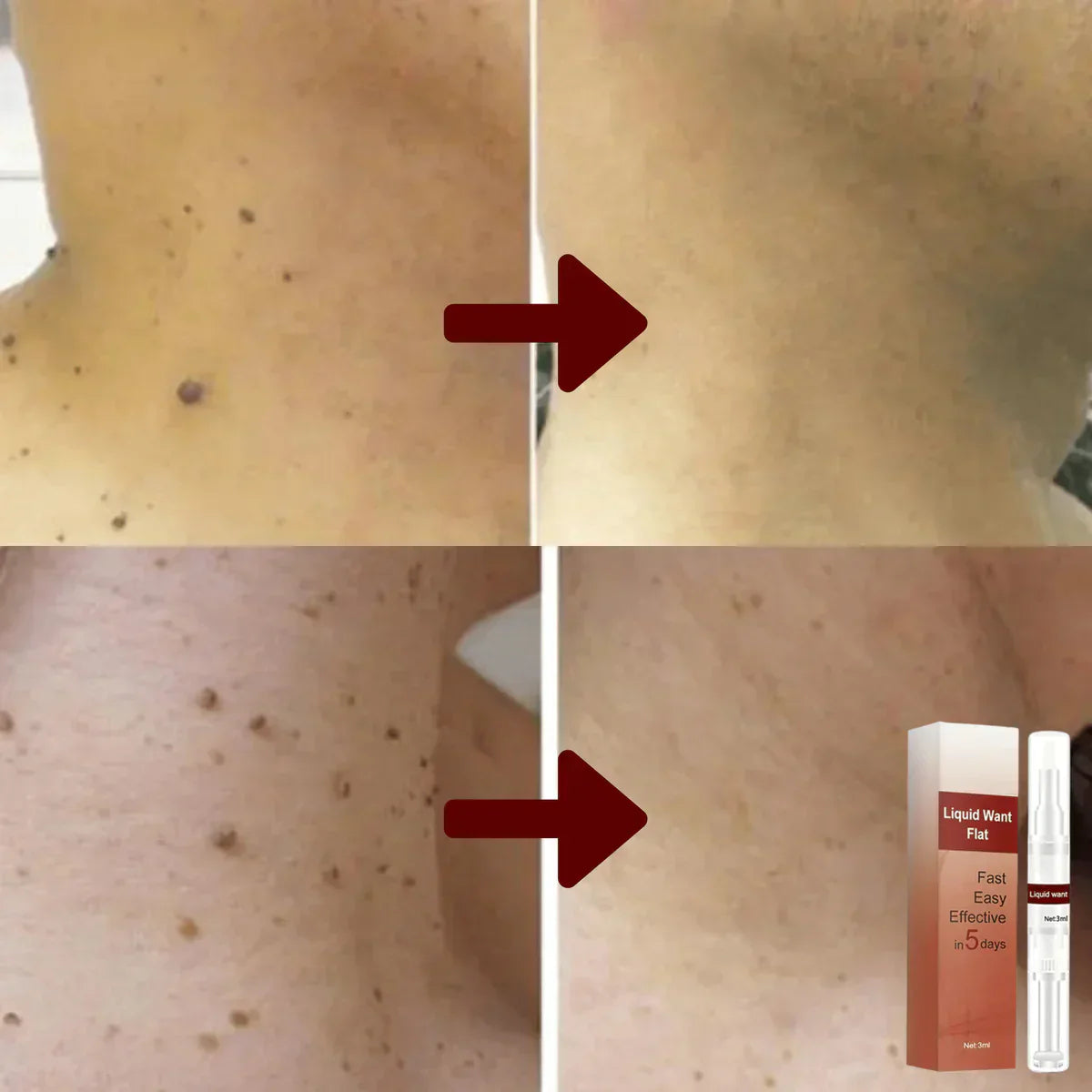 1 + 1 Gratis | Clariskin™ | Hartnäckige Flecken und Warzen entfernen