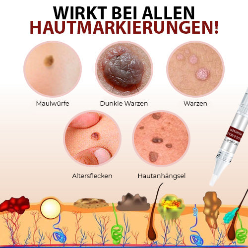 Hautentferner für Tags und Muttermale – wirksame und einfache Behandlung in 5 Tagen, 3ml Präzisionsstift