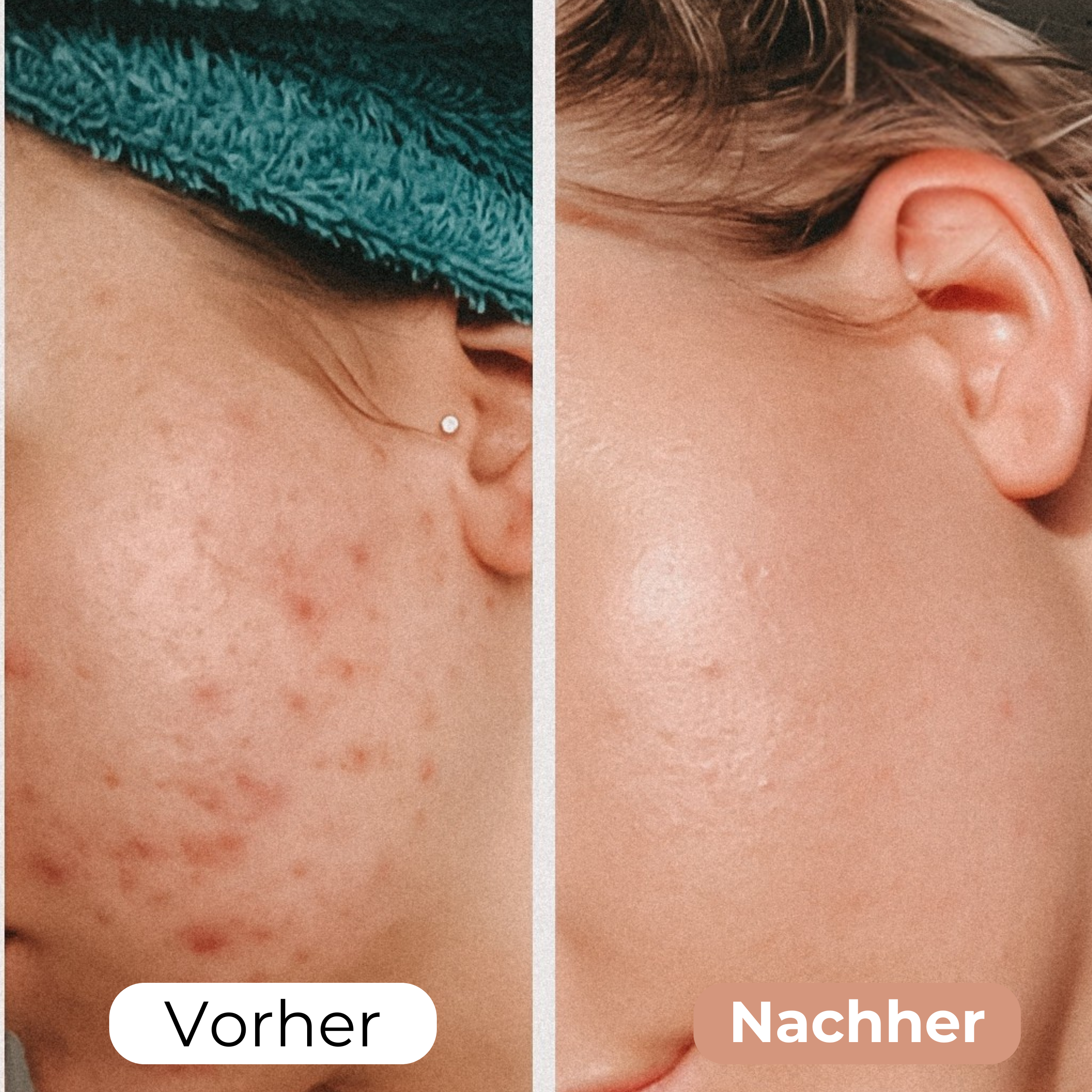 FaltenWeg™ - Medizinisches Silikonband gegen Falten!