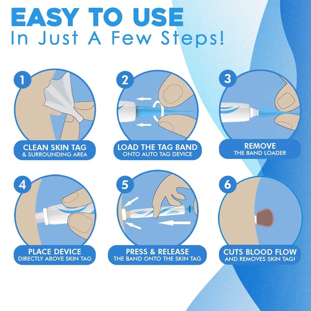 Auto Skin Tag Remover Kit – schmerzfreies Hautanhängsel-Entfernungsset mit Präzisionsapplikator, Gummibändern und Ersatznadeln für Gesicht und Körper