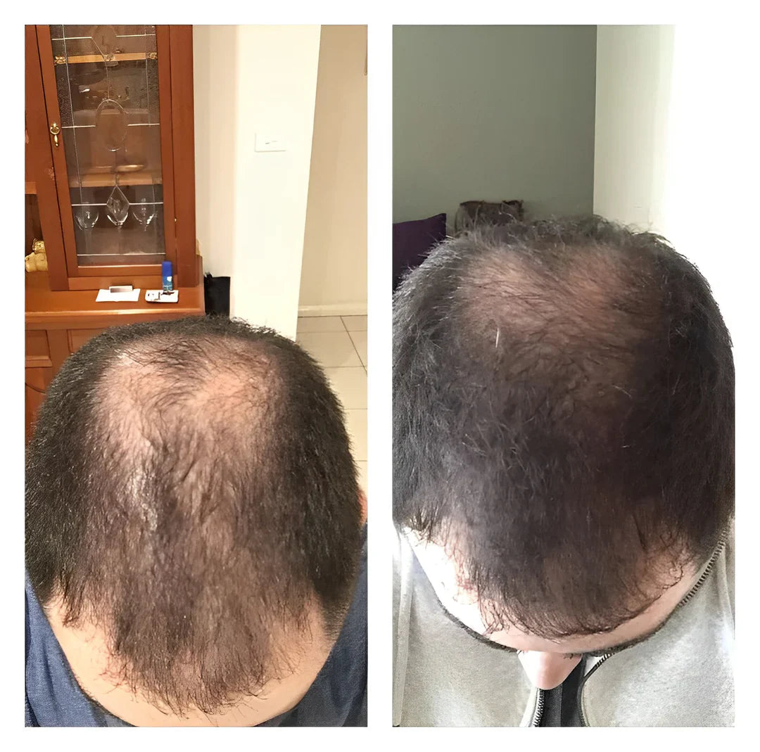 1+1 GRATIS | RegrowBar™ | Anti-Haarausfall