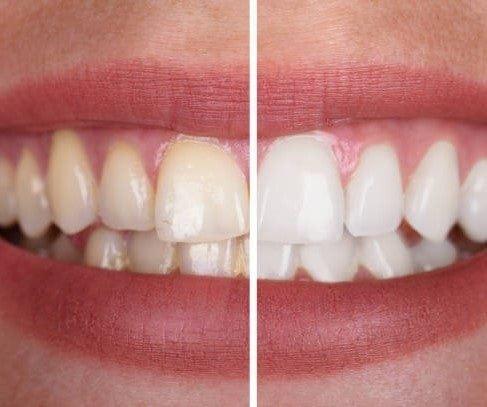 1+1 GRATIS | PureSmile® | Zahnaufhellungsset für ein strahlendes, langanhaltendes Lächeln