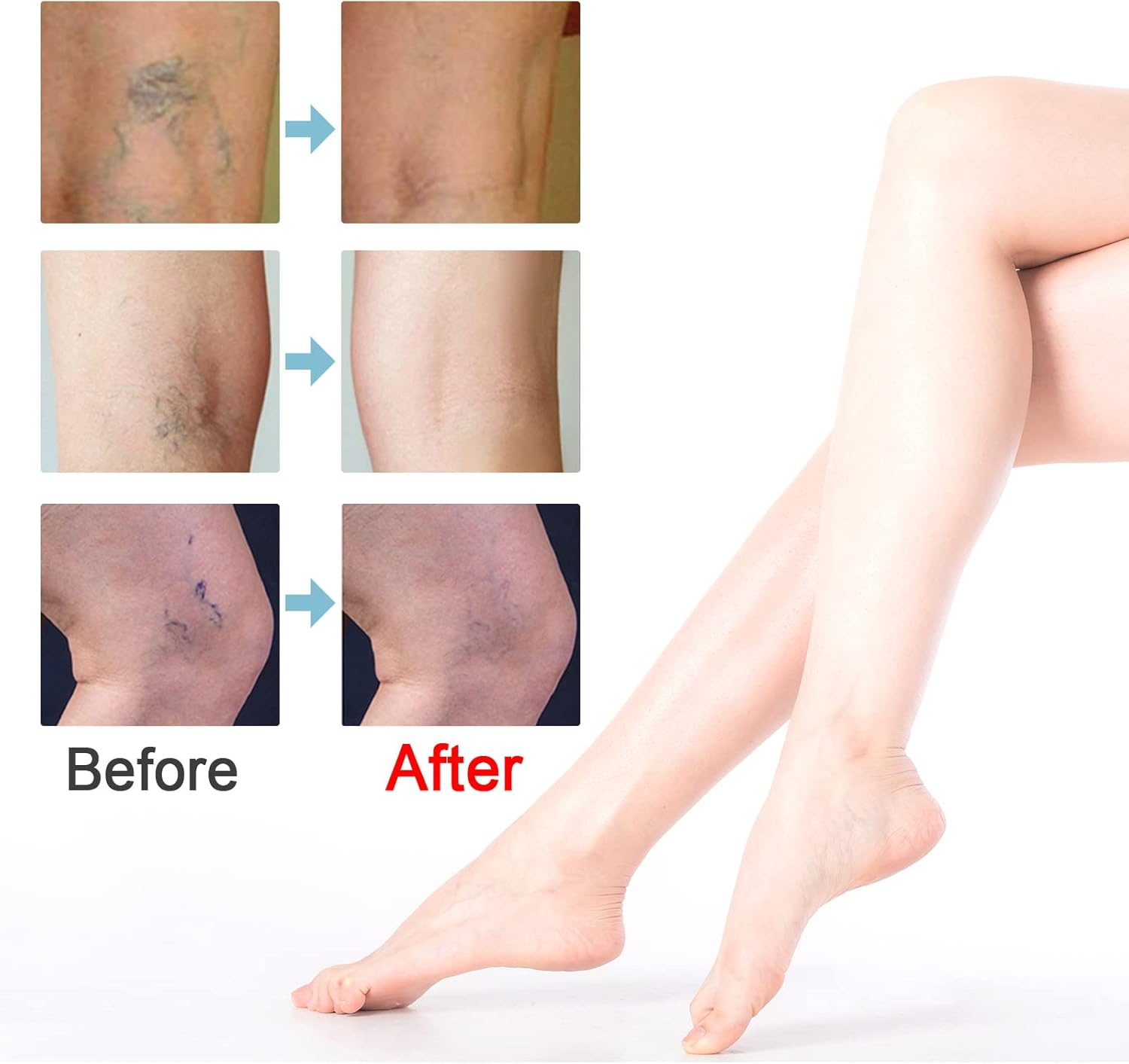 50% RABATT | VeinEase™ | Glättet und Beruhigt Müde Beine
