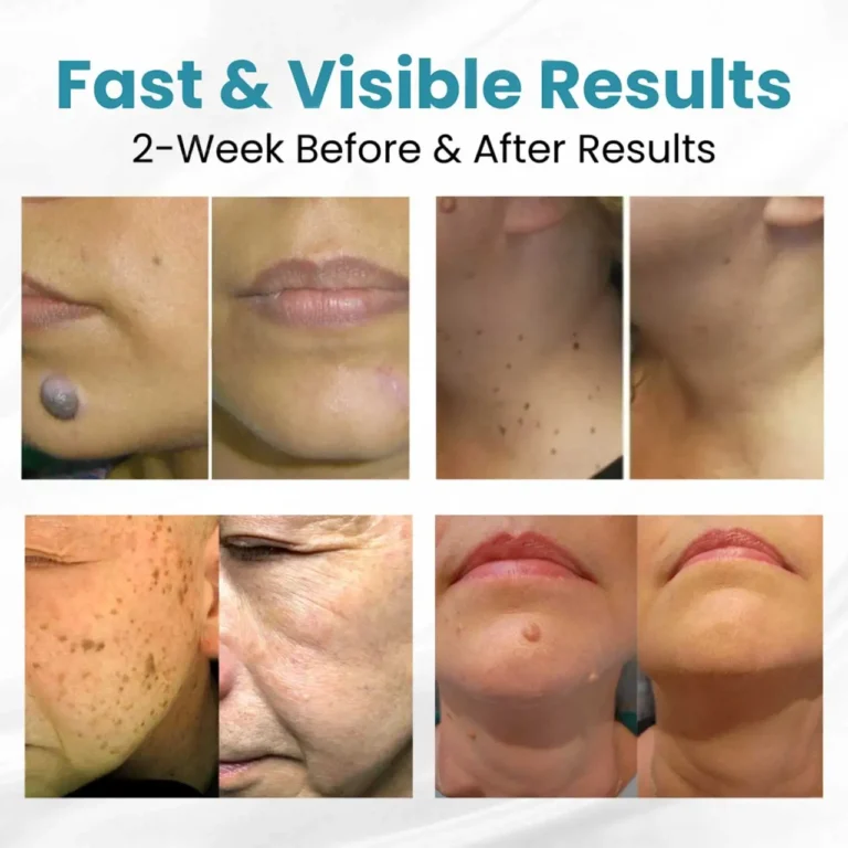 50% RABATT | SkinRenew™ | Sichere, Sanfte und Wirksame Hautpflege