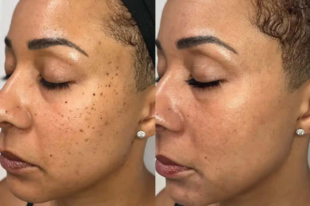 50% RABATT | SkinRenew™ | Sichere, Sanfte und Wirksame Hautpflege
