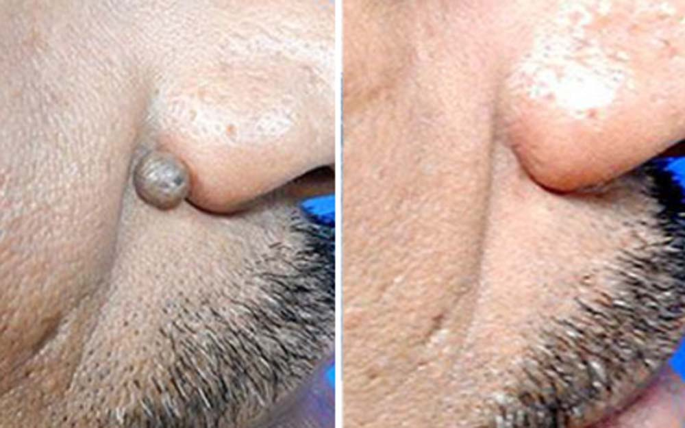 50% RABATT | SkinRenew™ | Sichere, Sanfte und Wirksame Hautpflege