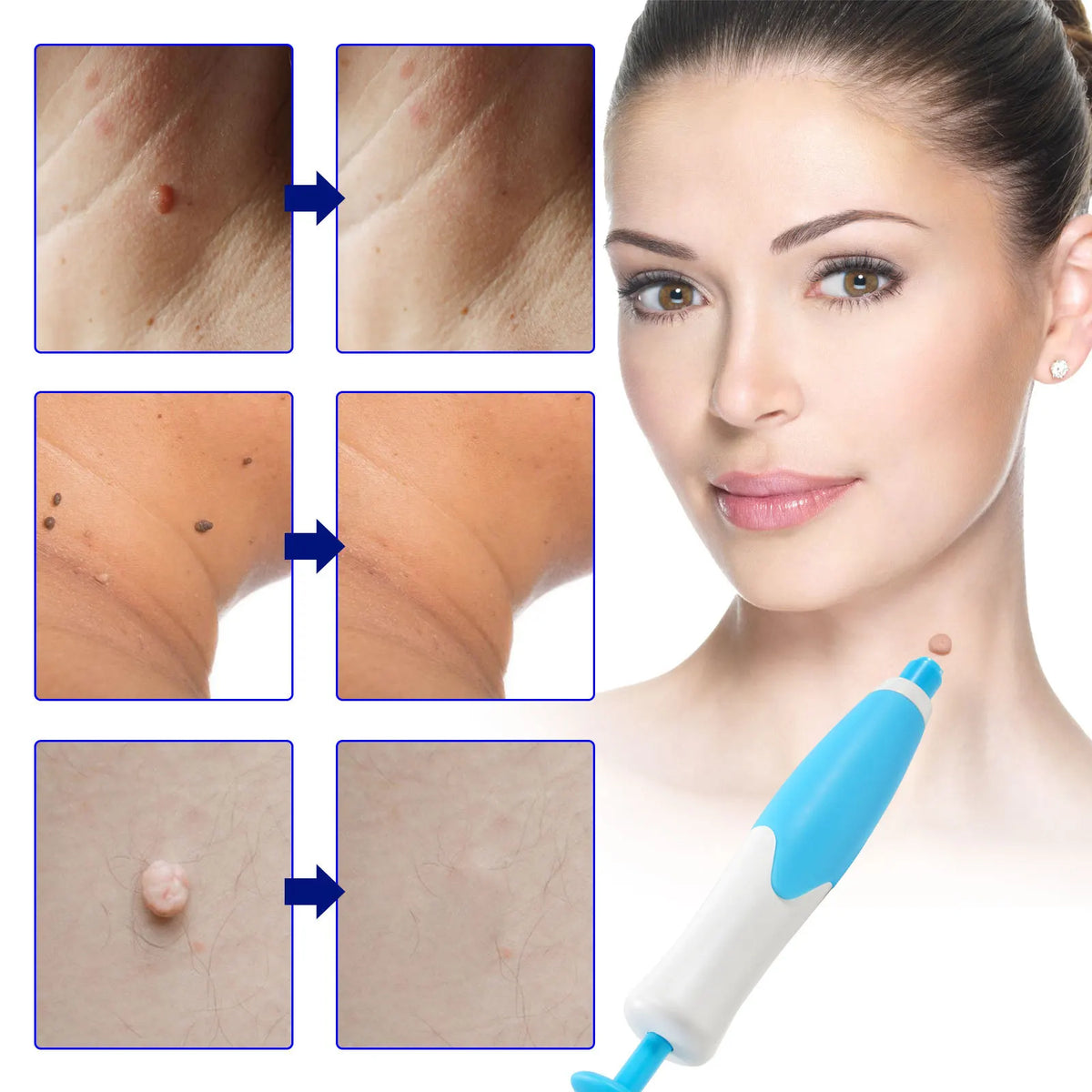 Dermavex™ | Hautanhänger Entferner – Sanft & Wirksam