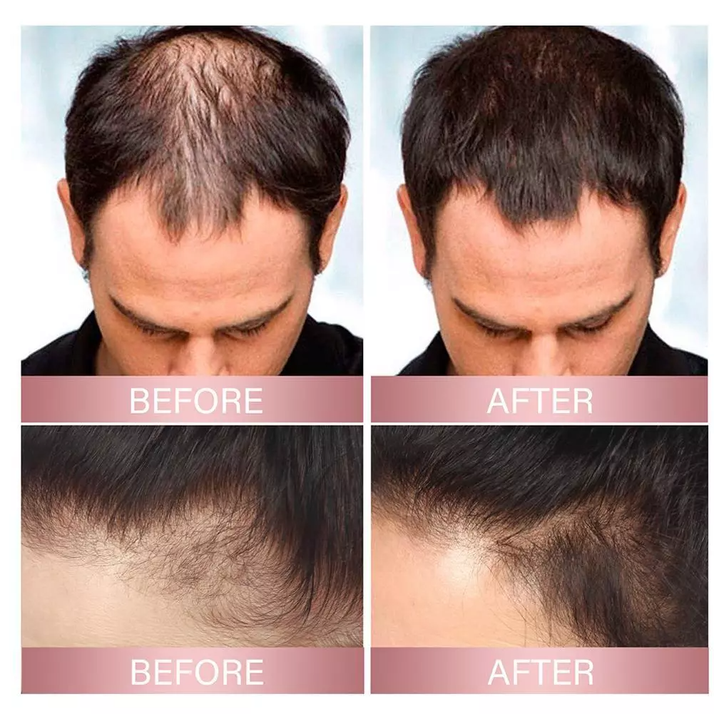 50% RABATT | FollicleFuel™ | Schnelles Vertrauen in Ihr Haar Wiederherstellen