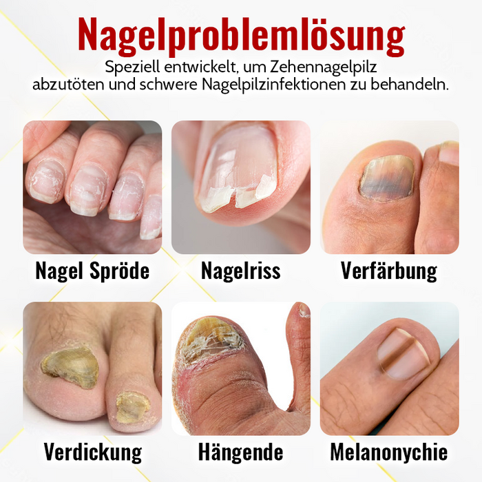 1+1 GRATIS | FungiFix™ | Onychomykose Rapid Relief Öl