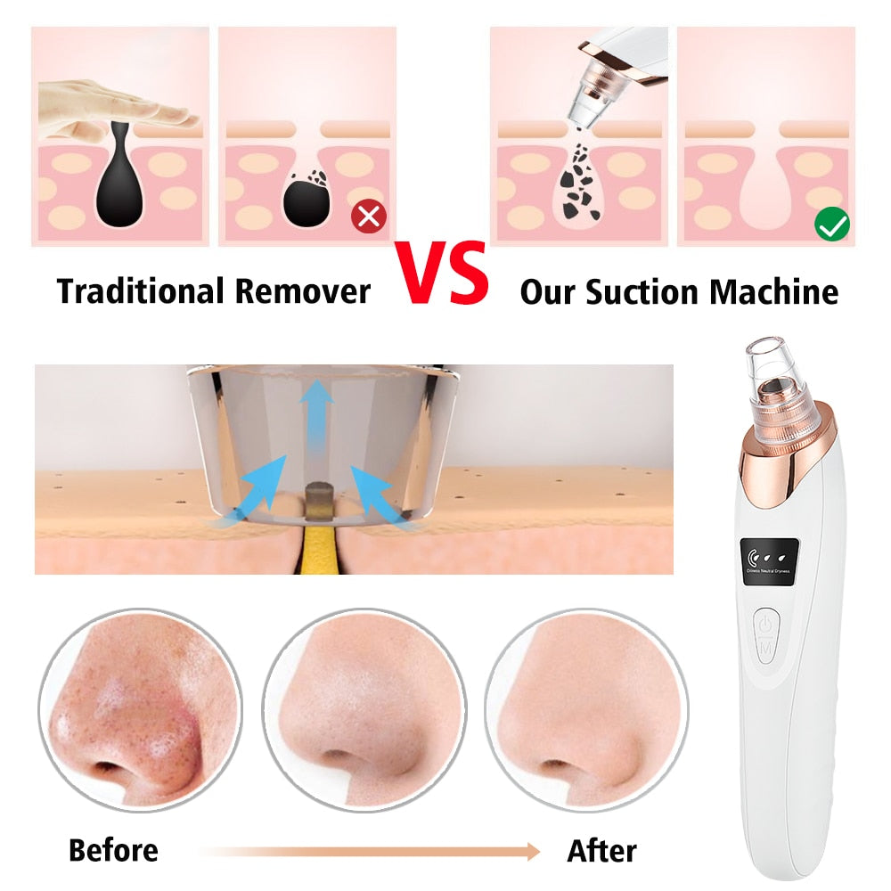 ClearSkin® | Poren-Mitesser-Entferner-Werkzeug