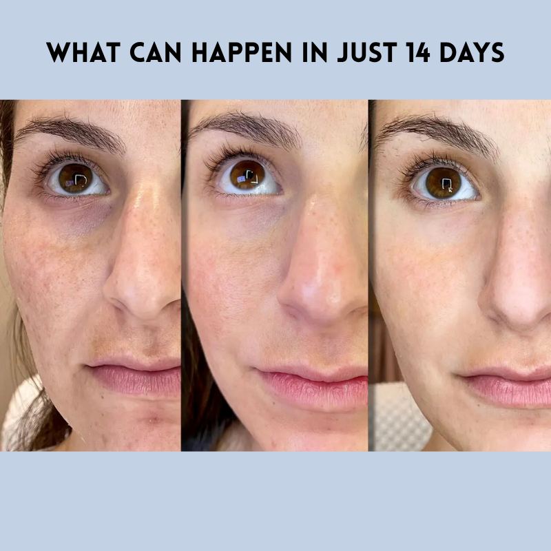 LiftDefine® | Anti-Aging-Streifen