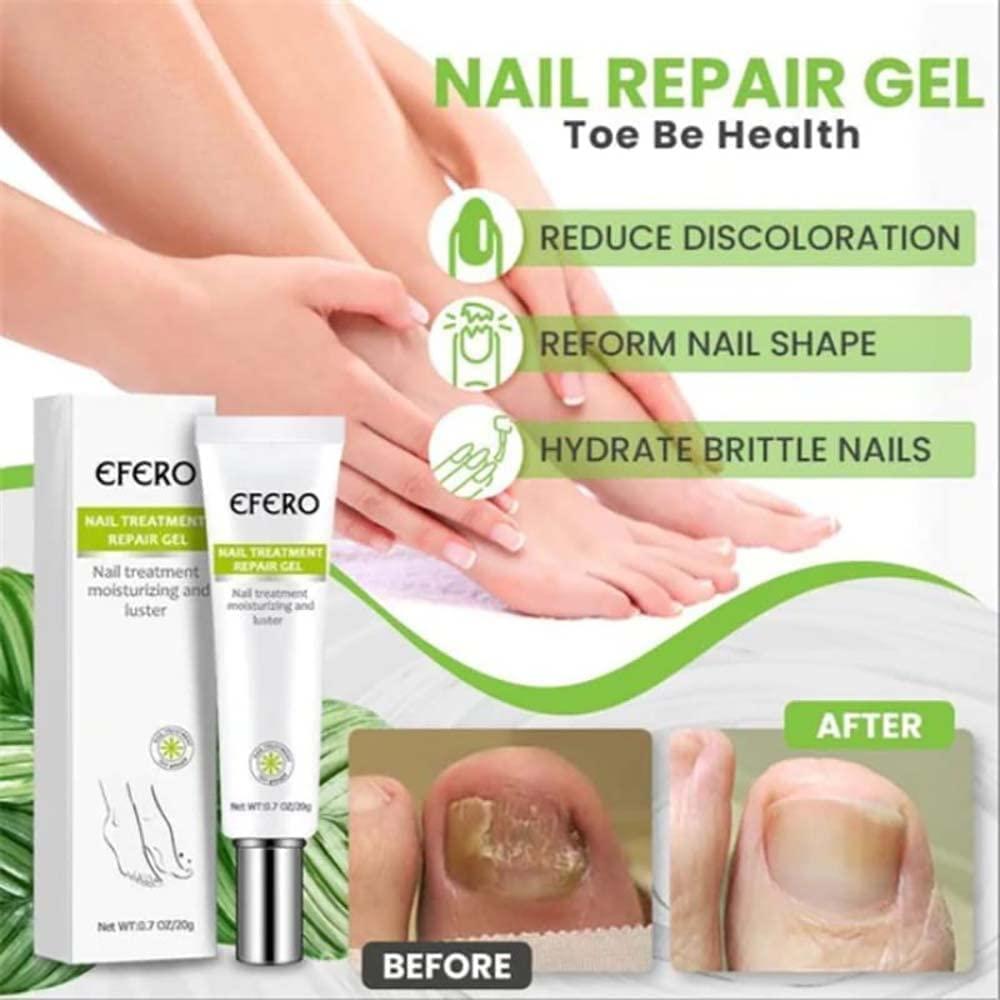 1+1 GRATIS | NagelFix™ - Kraftvolle Nagelreparatur: Starke, Gesunde Nägel!