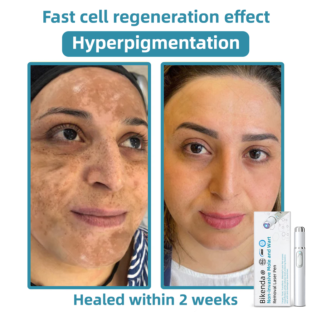 DermaZap® | CO₂-Laser-Entfernungswerkzeug