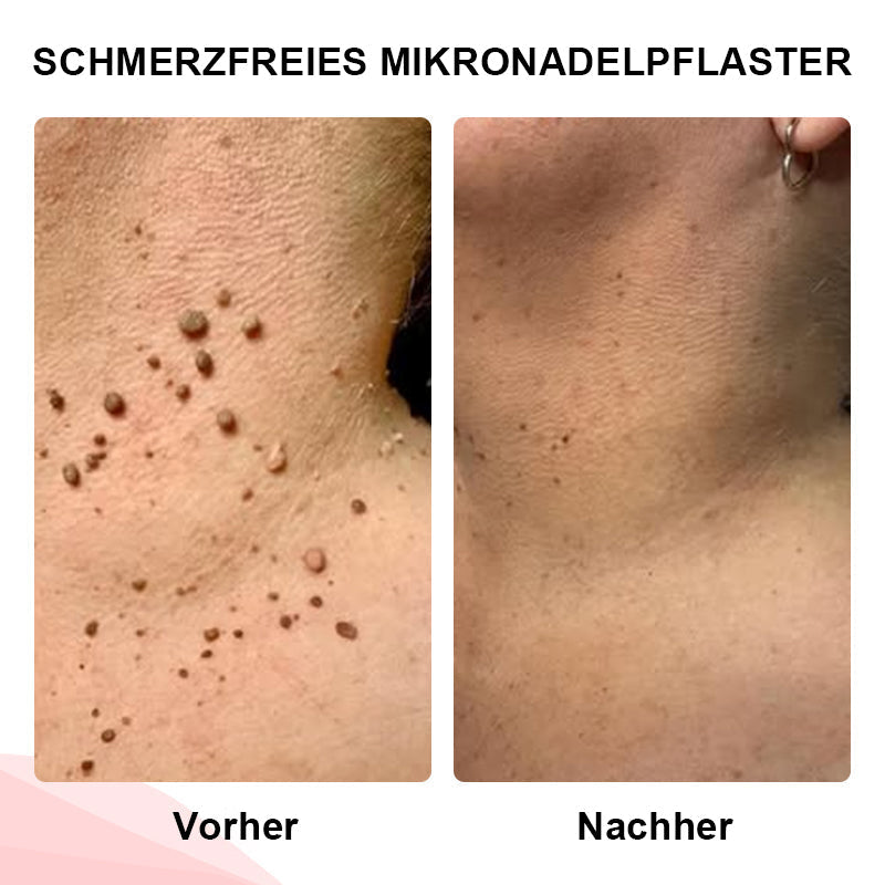 1+1 GRATIS | DermiClear™ Schmerzfreie Entfernung von Hautanhängseln