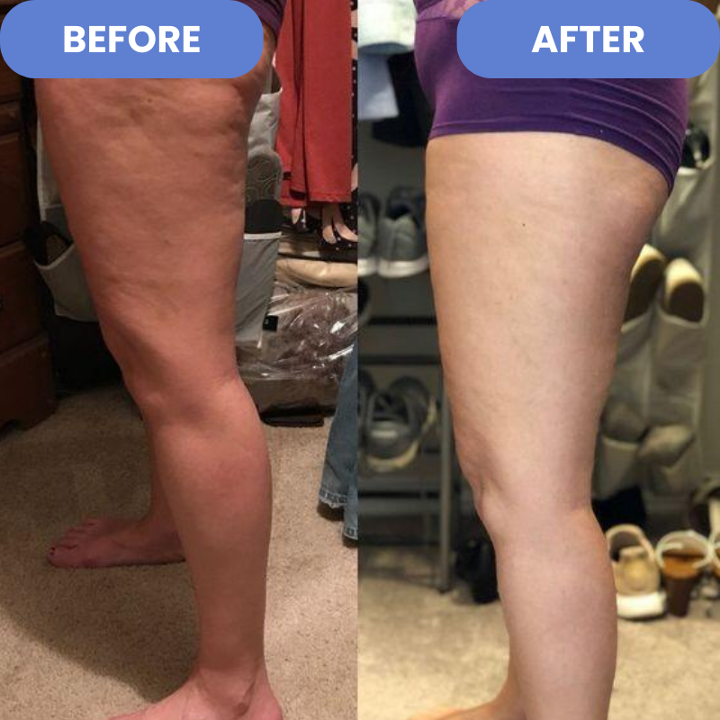 50% RABATT | Cellurelle™ | Anti-Cellulite-Entferner
