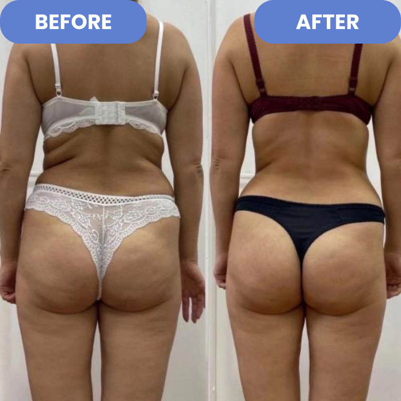 50% RABATT | Cellurelle™ | Anti-Cellulite-Entferner