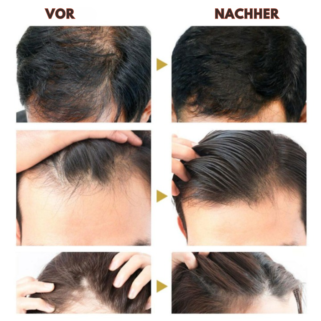 1+1 GRATIS | PurcPure™ | Haarwachstum Ingwer Essenz Öl
