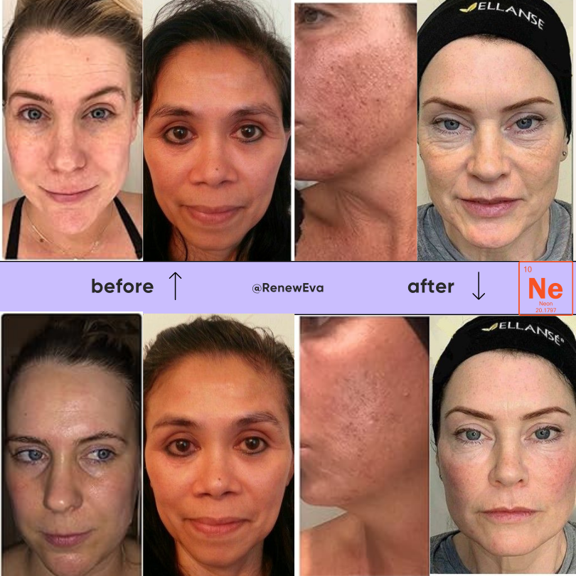 Radiavie™ | Werkzeuge zur Faltenentfernung