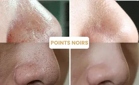 1+1 GRATIS | Hautmaske™ | Reinigen Sie alle Unreinheiten mit nur einem Zug!