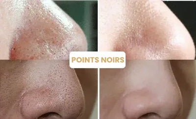 1+1 GRATIS | Hautmaske™ | Reinigen Sie alle Unreinheiten mit nur einem Zug!