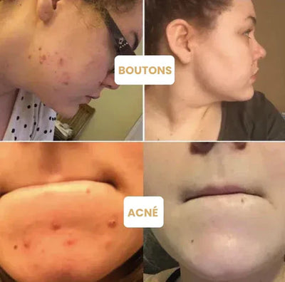 1+1 GRATIS | Hautmaske™ | Reinigen Sie alle Unreinheiten mit nur einem Zug!