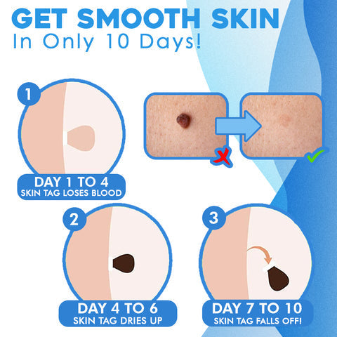 Auto Skin Tag Remover Kit – schmerzfreies Hautanhängsel-Entfernungsset mit Präzisionsapplikator, Gummibändern und Ersatznadeln für Gesicht und Körper