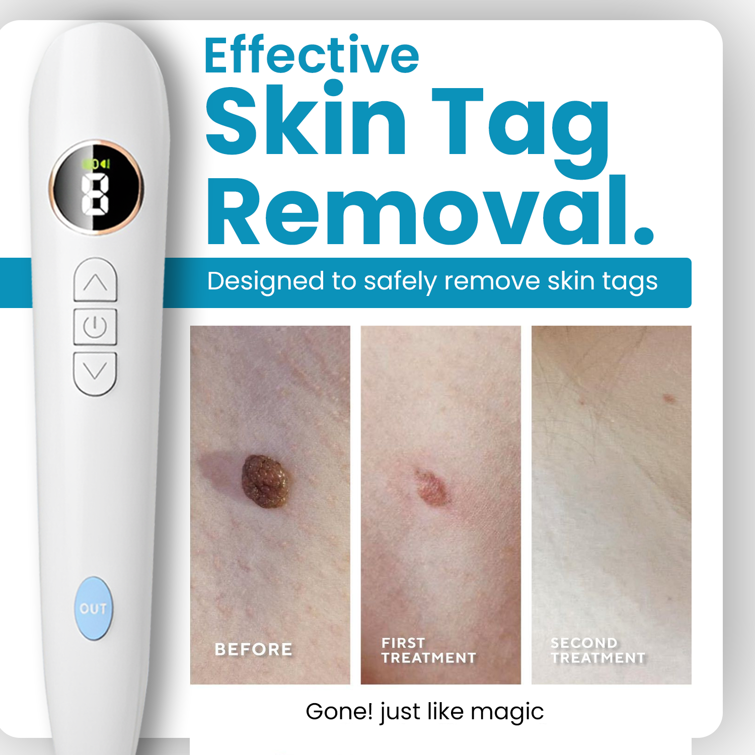 Gentiva™ | CO2-Laser für den Hausgebrauch Shot Erase Pro