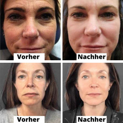 10+10 GRATIS | PuriMe™ | Waschfreie Kollagen-Straffungsmaske