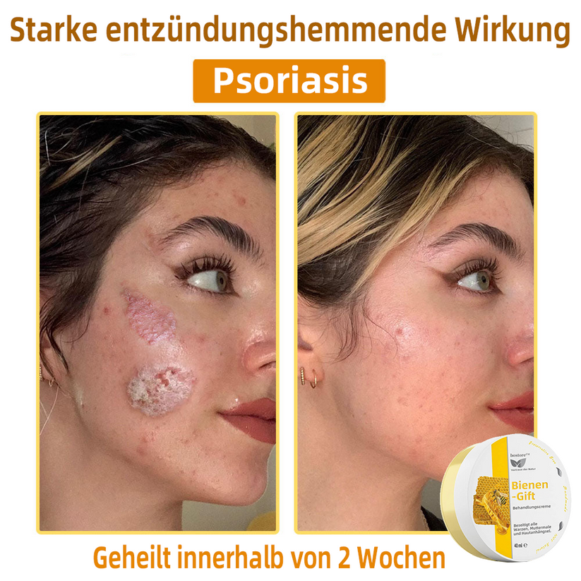 50% RABATT | ApisRelief™ | Natürliche Hautlösung