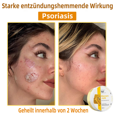 50% RABATT | ApisRelief™ | Natürliche Hautlösung