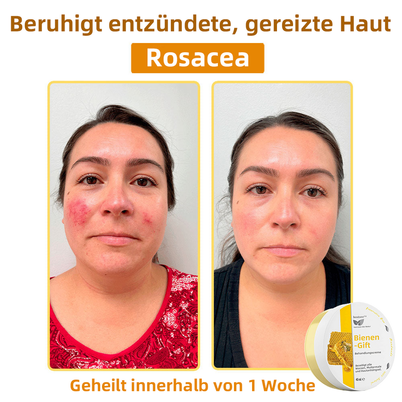50% RABATT | ApisRelief™ | Natürliche Hautlösung