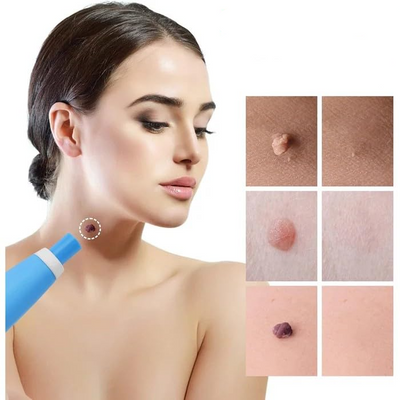 50% RABATT | Dermavex™ | Hautanhänger Entferner – Sanft & Wirksam