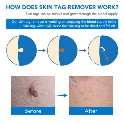 50% RABATT | Dermavex™ | Hautanhänger Entferner – Sanft & Wirksam